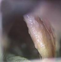 C Fig. 5. Vocal cord mucosectomy with PDL. : Vocal cord leukoplakia was observed on the vocal cord.