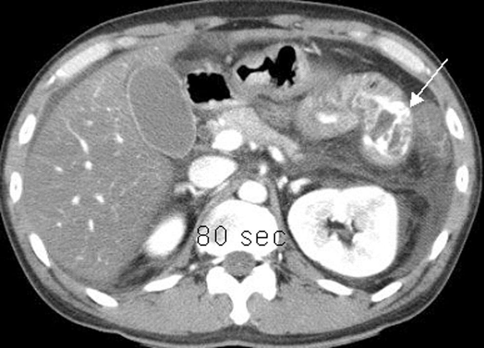 Fig. 2. CT during SMA angiography.