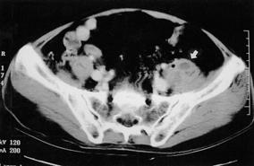 김정민외 6 인 : 정상성인에서의살모넬라척추골수염 Figure 3. Computed tomography of abdomen. There is a poorly defined low density lesion along left psoas muscle with tiny air bubbles, suggesting psoas abscess. Figure 2.