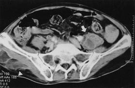 대한내과학회지 : 제 69 권부록 3 호 2005 Figure 5. Followup computed tomography of abdomen. The size of left psoas abscess (arrow) is increased and new abscess in right buttock area (arrowhead) is developed.