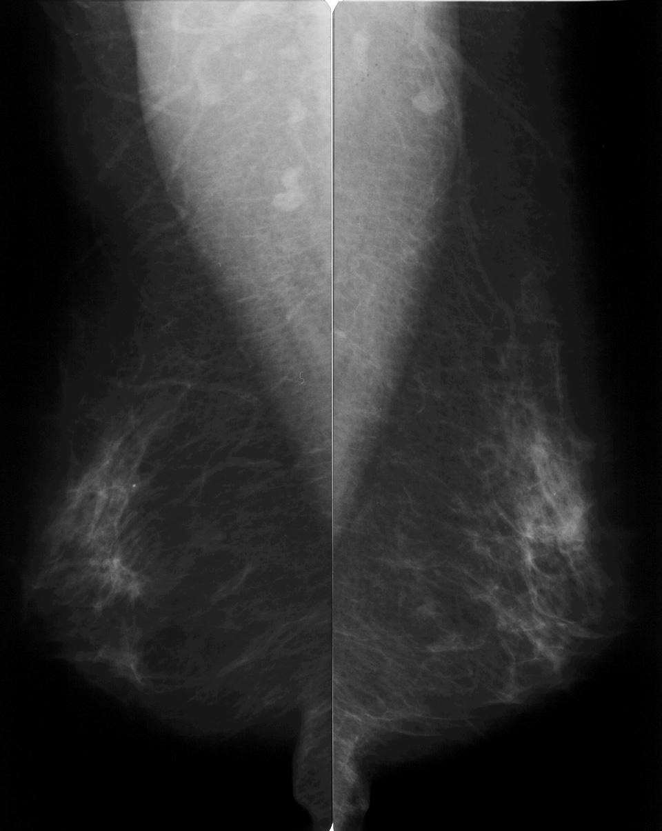 대한영상의학회지 2005;53:451-456 Fig. 1. A 58-year-old woman with the presence of scattered fibroglandular densities. A, B. Mediolateral oblique and craniocaudal screening mammograms reveal no abnormality. C.