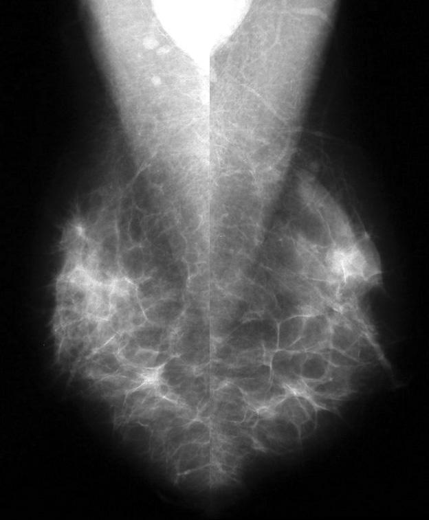 Fig. 2. A 50-year-old woman with heterogeneously dense breasts. A, B.