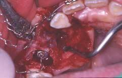 Panoramic view and intraoral photograph of 57months after treatment. 2.