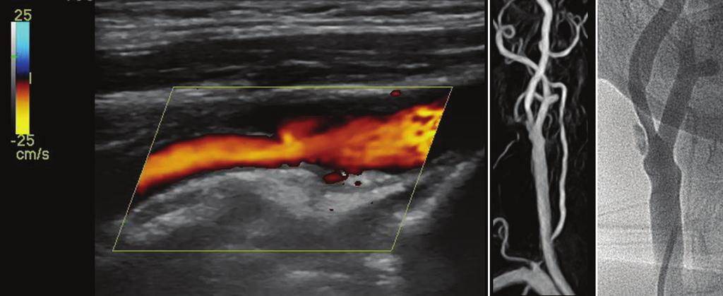 Journal of Neurosonology Vol. 1, Suppl. 1, 2009 A B C Fig. 1. Color Doppler-assisted duplex imaging (A), MR angiography (B), and conventional angiography (C) of carotid stenosis with ulcerative plaque.