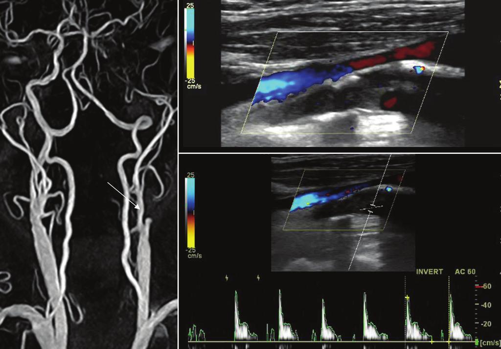 Journal of Neurosonology Vol. 1, Suppl. 1, 2009 B A C Fig. 3. MR angiography (A) and color duplex sonography (B, C) of left internal carotid occlusion (arrow).