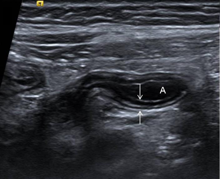Dae Hyun Kim. Ultrasonography of appendicitis Clinical Ultrasound 여서복막염의위험성이증가한다 [53,56]. 임신중의충수염 (appendicitis in pregnancy, Fig.