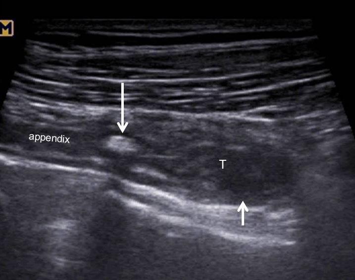 Clinical Ultrasound Vol. 1, No. 1, May 2016 비만환자의충수염 (appendicitis in obese patient, Fig. 21) 비만환자에서는두꺼운복벽의지방층에의해서음향감쇠가 증가하고초음파빔의투과가감소됨으로써깊숙한위치에있는 충수의관찰이힘들다 [65].