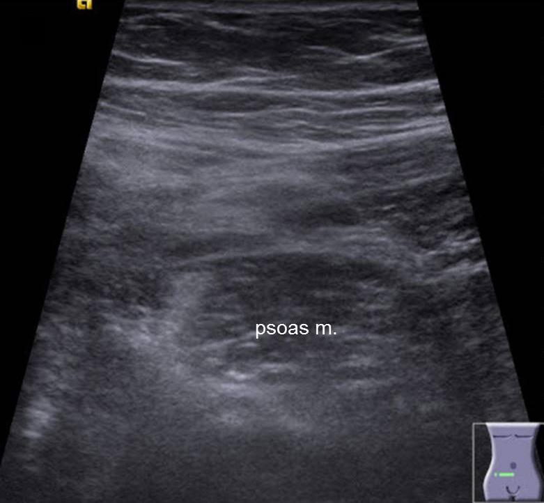 26-year old obese male (body weight: 115 kg) with suppurative appendicitis. () In supine position, appendix was not visualized due to severe obesity.