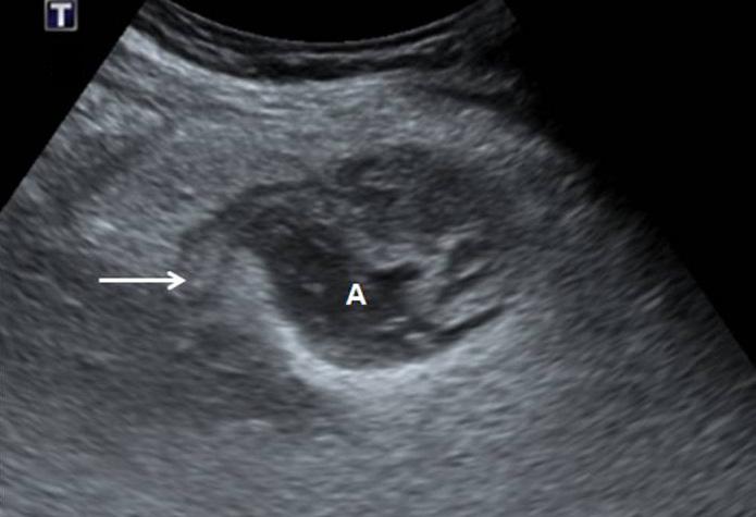 Dae Hyun Kim. Ultrasonography of appendicitis Clinical Ultrasound C D Figure 23.