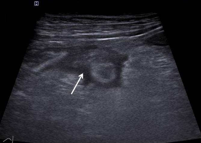 () 70-year old female with perforated appendicitis.