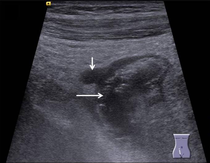 wall of appendix (arrows). (C) 70-year old female with perforated appendicitis.