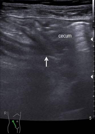 (D) 36-year old female with perforated appendicitis demonstrating normal appearing