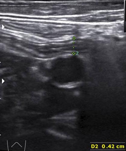 Clinical Ultrasound Vol. 1, No. 1, May 2016 압박초음파는충수염을진단하는데있어서는유용한진단방법이라는것이과거의여러보고에서입증되었지만천공성충수염을진단하는데있어서는아직까지논란이적지않다 [81,82].