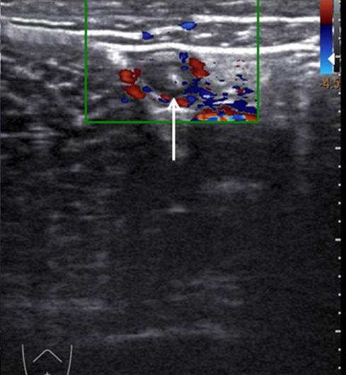 (C) Transverse section of appendix showed hyperemia of appendiceal wall on color doppler study (arrow).