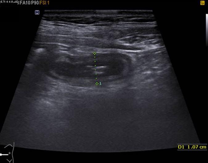 Dae Hyun Kim. Ultrasonography of appendicitis Clinical Ultrasound 으로알려져있다. 임상적으로증상이회복된환자중에서재발률이 38% 로알려져있고시기는평균 14주였고 70% 에서는 1년이내에재발되었다.