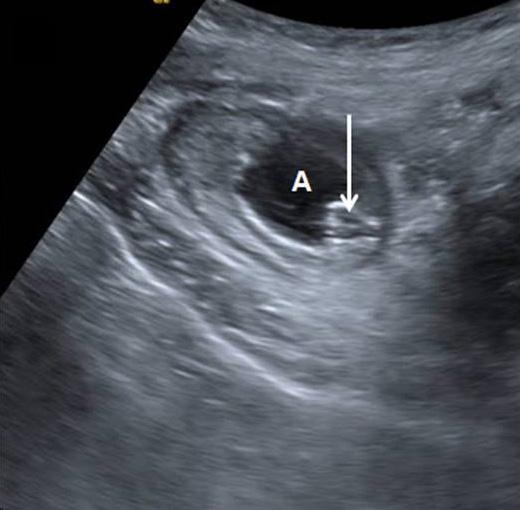 () Transverse section of appendix (calipers) showed round distended with maximal outer diameter of 10.2 mm. Note echogenic appendicolith (arrow) with acoustic shadowing.