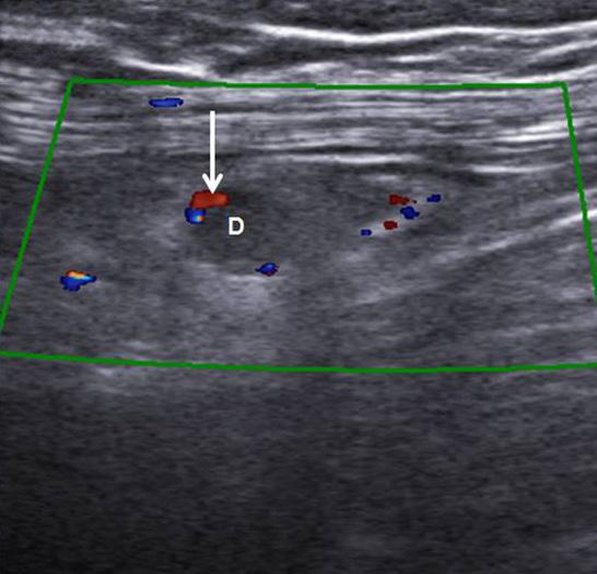 (C) On color doppler study of same patient, mildly increased blood flow (arrow) is observed within the wall of appendiceal diverticum (D). D, appendiceal diverticulum.