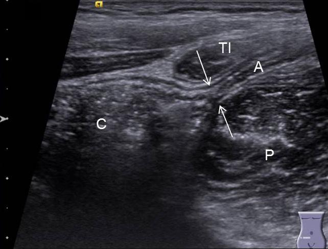 lso noted appendix () lying between terminal ileum (TI) and psoas muscle (P).