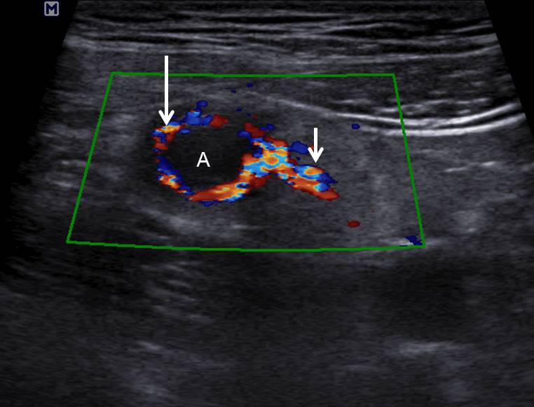 Dae Hyun Kim. Ultrasonography of appendicitis Clinical Ultrasound 생할수있다. 천공성충수염에서는충수주변의농양, 액체저 류부위에충수분석을관찰할수도있다 [27].