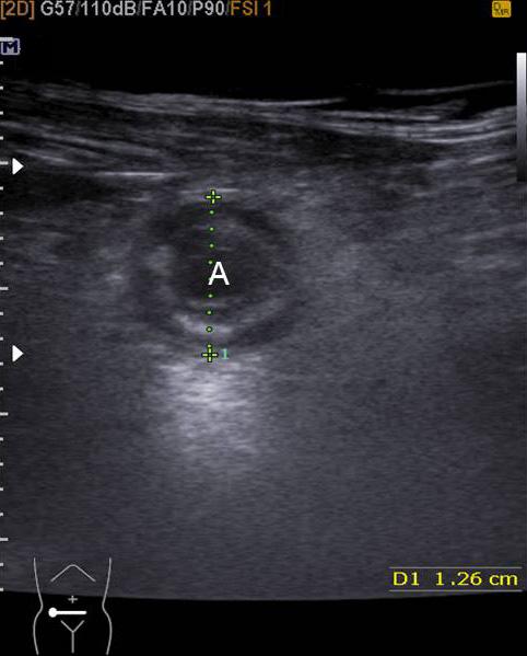 복통환자의초음파검사에서고에코성지방병변이관찰되 Figure 6. Dual gray scale compression transverse section of appendix.