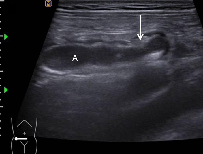 () Longitudinal section showed mildly distended tubular structure with intraluminal exudates and feces (). Note no thickening of submucosal layer (short arrow).