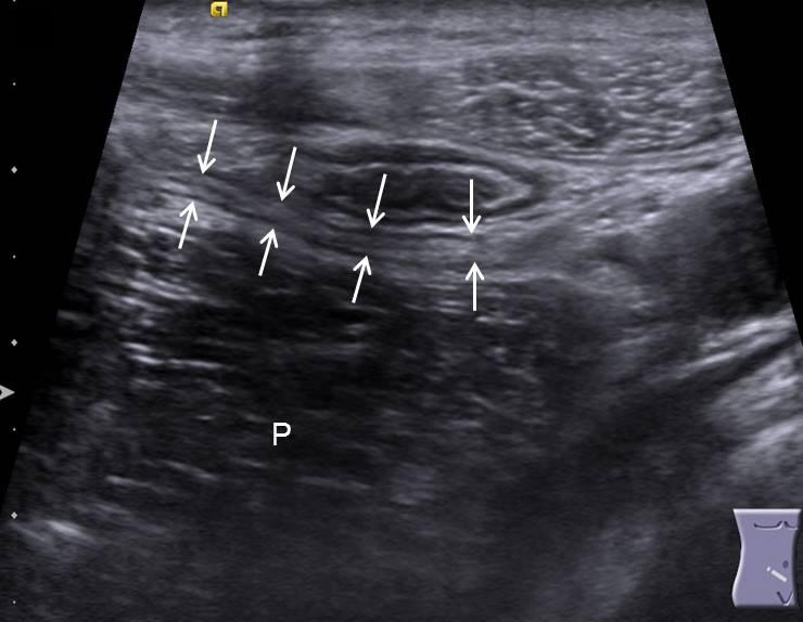 Note that anterior aspect of submucosal layer is intact (arrow), indicating no circumferential gangrene of appendix.