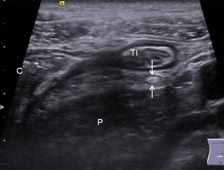 submucosal layer of anterior wall (arrows).