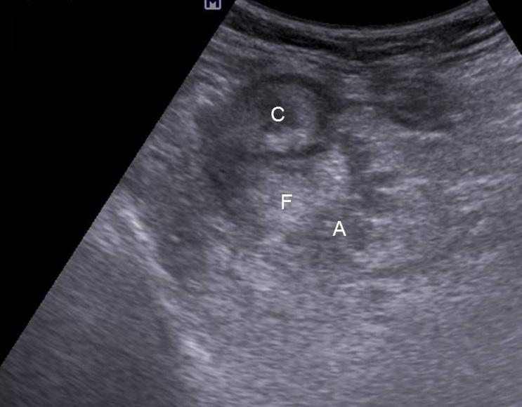 Dae Hyun Kim. Ultrasonography of appendicitis Clinical Ultrasound C D Figure 16.