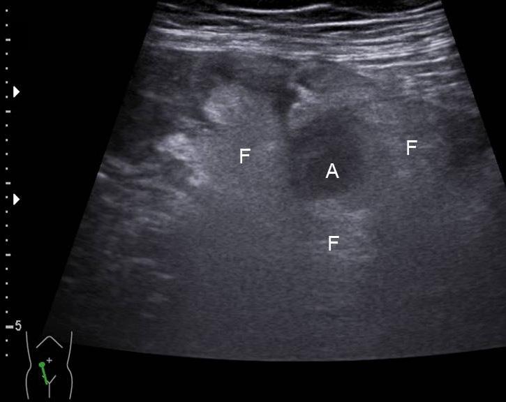 () Note anechoic fluid collection indicating abscess () inferior to the cecum.