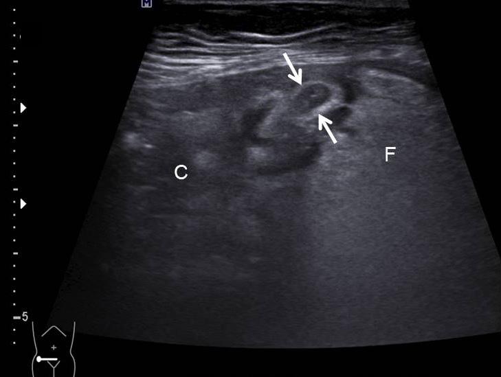 Note markedly increased echogenicity of periappendiceal fat (F) surrounding inflamed appendix which