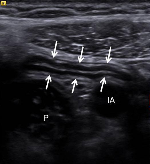 (D) Transverse view of right iliac fossa showed anechoic fluid collection indicating periappendiceal
