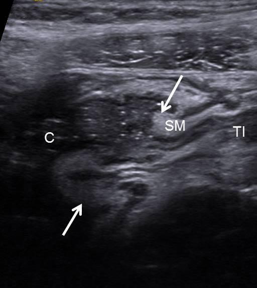 lso noted increased echogenicity within periappendiceal inflamed fat (F).