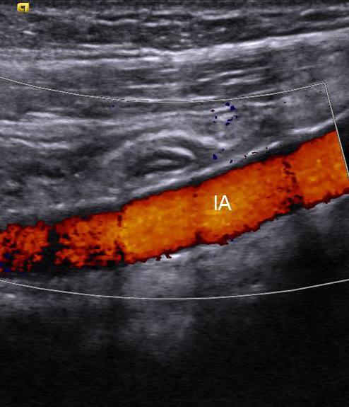 () Long axis image of ileocecal valve (arrows) showed marked wall thickening.