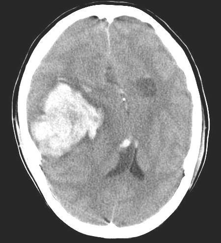to 3% yearly. 16) A B C D Fig. 2. T1W1 MRI, axial view of the 49-year old female patient, showing low signal mass at right temporal lobe A.