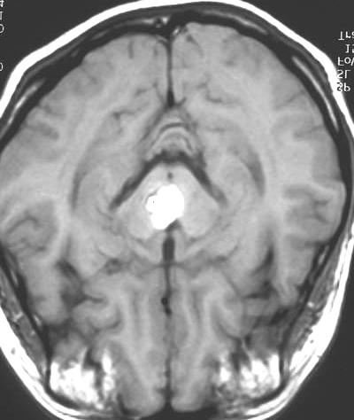 deficit Hemorrhagic stroke Headache (acute) Seizure Fig. 4.