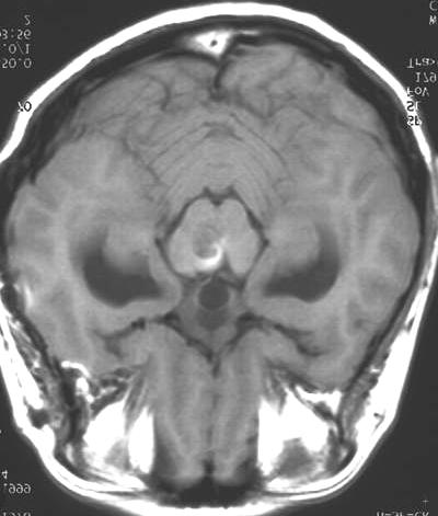 5. The T1W1 weighted MRI, axial view of the 19-year-old female patient who