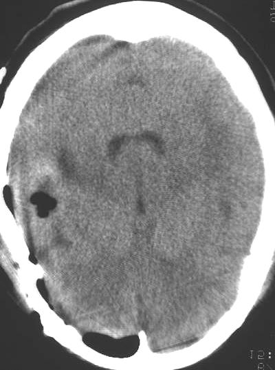 Medial longitudinal fasciculus Nucleus of hypoglossal nerve Tralctus solitarius A B C App III CN Fig. 7. AVentral view of brainstem.