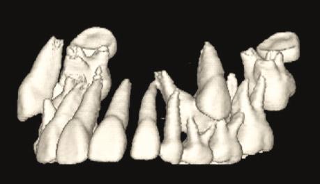 Complete transposition of the bilateral maxillary canines and first premolars.