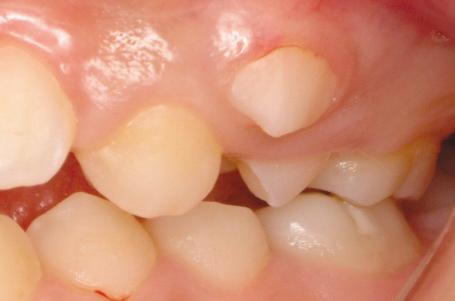 Generalized crowding and the mandibular 3 incisor were observed.