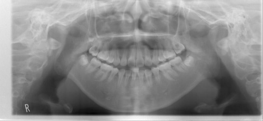 Fig. 6. Final records. Panoramic view. The 4 first premolars were extracted and crowding was eliminated.
