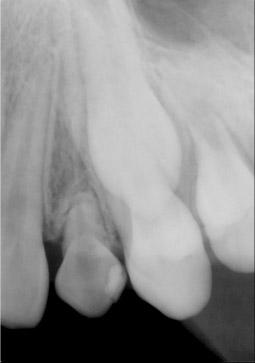 Primary canines on both sides are remained. With the exception of the canines, all permanent teeth in the arch were erupted. Left view.