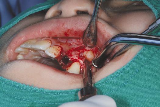 The root apex of the maxillary left