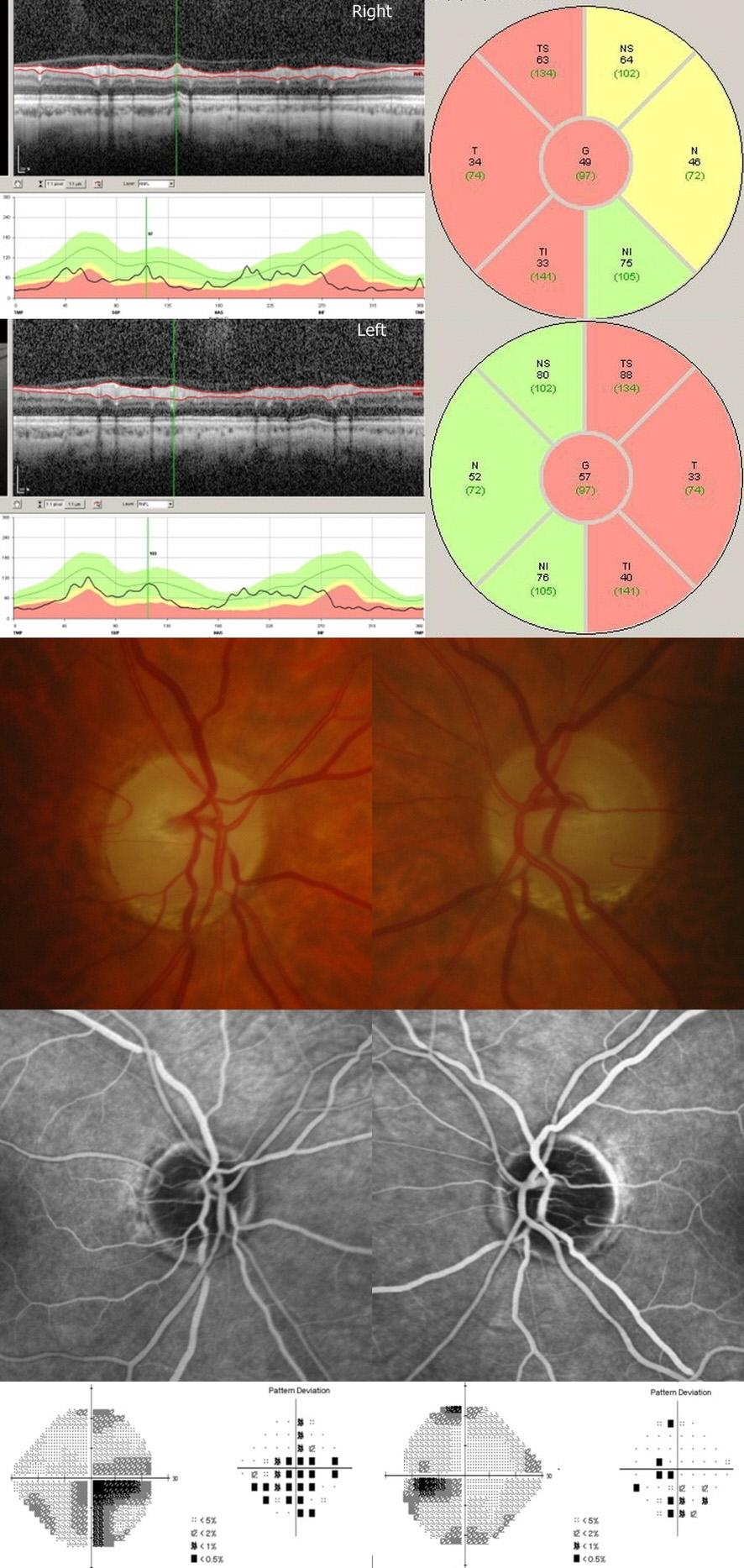 (A) At initial presentation, RNFL thickness values exceed normal limit of both eye. The optic disc is swollen and margin of the optic disc is not clear. Late phase FAG showed leakage at optic disc.