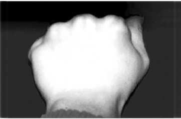 204 강호정ㆍ송계욱ㆍ박관규외 2 인 흔히권투선수골절 (boxer s fracture) 이라고불리는 제 5 중수골경부골절은전체수부골절의 20% 를차지할정도로가장흔한수부골손상이다 6). 이골절은주먹을쥔상태에서물체를가격할때주로발생하며, 제 5 중수골은형태상다른중수골에비해가늘고, 위치상주위조직의보호가약하여비교적쉽게골절이발생하는것으로알려져있다 11).