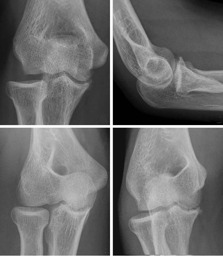 신동주 : 금속판을이용한구상돌기골절의치료 A B C D Fig. 1.