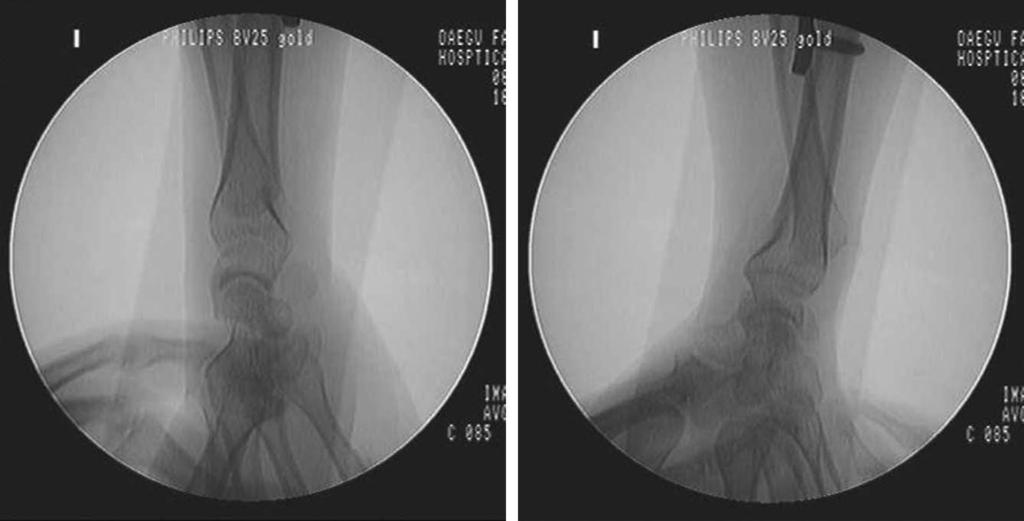 전인호 신동주 손영헌 이병우 김풍택 Fig. 6. (A, B) Stability of DRUJ was ckecked during passive rotation of forearm under fluoroscopy. Fig. 7.