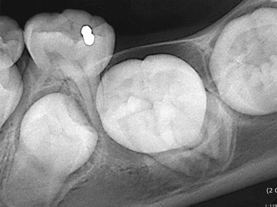 show impacted lower left first molar. Fig. 9.