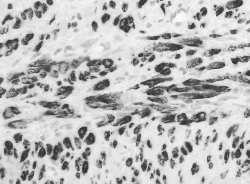 부인종양 제18권 3호 김형원 외 Fig. 4. Microscopic findings; (A) On low power field, a well-demarcated spindle cell tumor is identified (left).