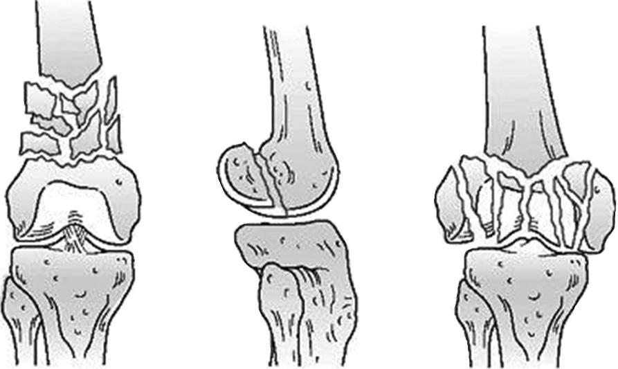 대퇴사두근및슬괵근은수직력으로작용하여후방굴곡변형을더욱조장하여골편들을중첩시키고, 근위골편을상슬개낭 (suprapatella pouch) 속으로전위시킨다내전근은내, 외반변형을야기하는데대부분의대내전근 (adductor magnus) 과장내전근 (adductor longus) 이근위골편에부