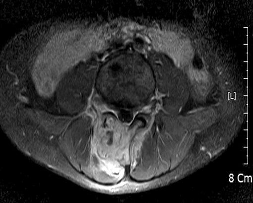 Computed tomography showed destructive bony lesion in lamina of right 4th lumbar. Figure 2.